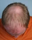 Before Hair Transplant&nbsp;2 Sessions (Areas)